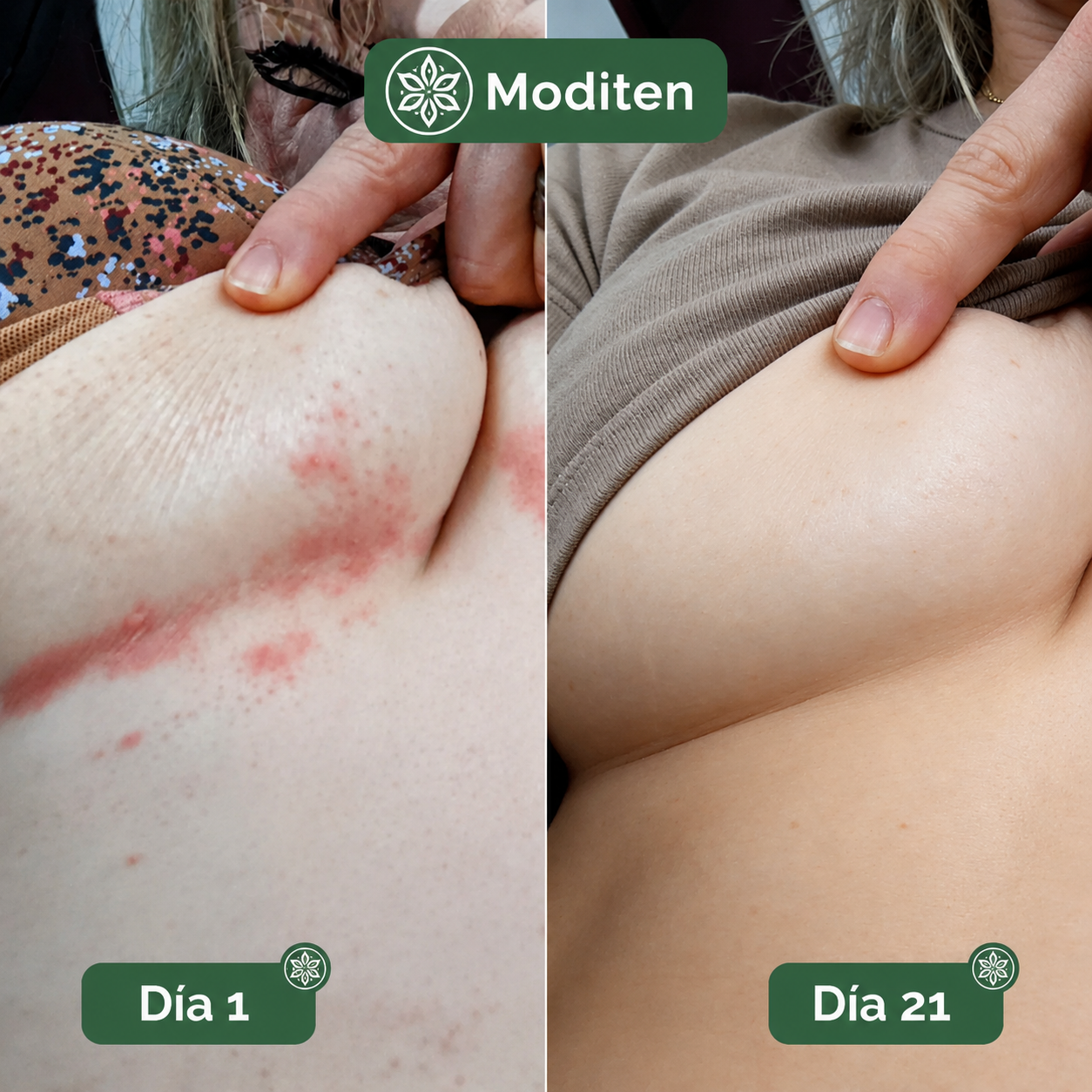 Jabón Íntimo Antimicótico Moditen™