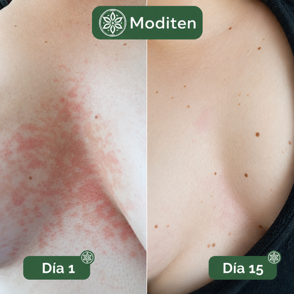 Jabón Íntimo Antimicótico Moditen™