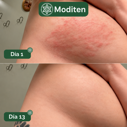 Jabón Íntimo Antimicótico Moditen™